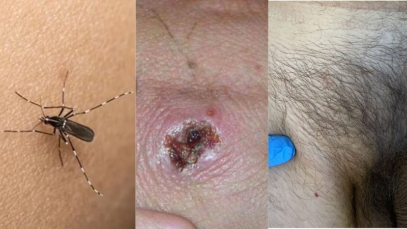 Cómo es la situación sanitaria de Mendoza sobre el dengue, viruela del mono y sífilis